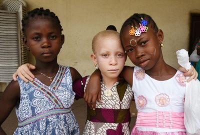 Albinism: lack of pigment plagued by deadly myths