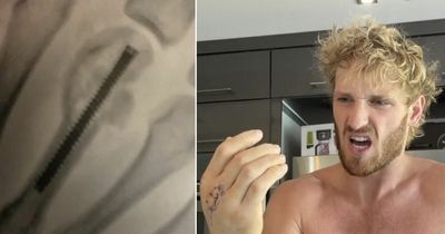 Logan Paul shows off 40mm screw after breaking hand on drunken night out