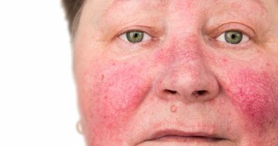 Cancer warning signs known to appear on the face that you shouldn't ignore