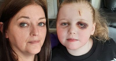 Glasgow schoolgirl who suffers up to 300 seizures a day 'robbed of her childhood'