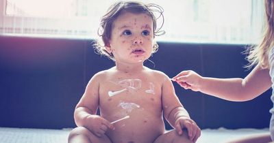 Unusual chickenpox symptoms to watch for - feeling irritable and having cold feet