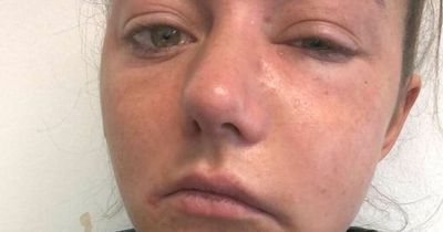 Dangerous infection saw woman's face swell 'like Elephant Man' - but A&E turned her away