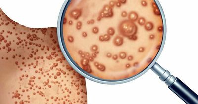 People confused over chicken pox and shingles, experts say