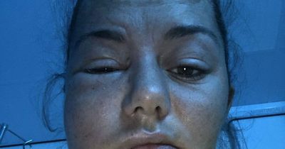 Amy could have died as face swelled 'like Elephant Man' after A&E sent her home