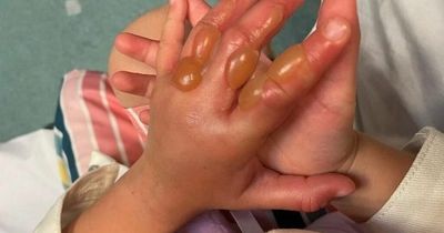 Child suffers horrific second-degree burns after touching 'Britain's most dangerous plant'