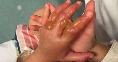 Child hospitalised with second-degree burns after touching dangerous plant