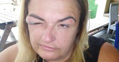 Gran, 43, faceplants in toilets as £35 bottomless prosecco brunch leaves her with huge swollen face