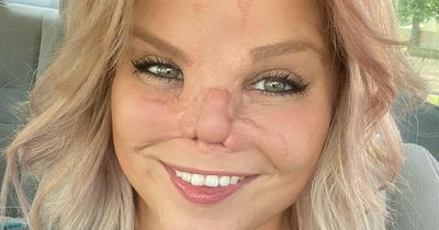 Brave woman whose nose was bitten off by Pitbull says she still loves dogs
