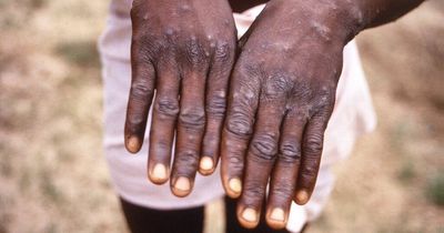 Why is it called monkeypox as scientists set to rename virus over racist connotations