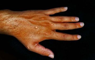 WHO to look into reports monkeypox could be sexually transmitted disease
