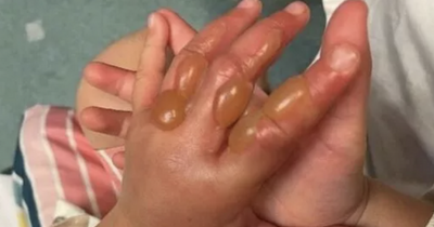 Girl, 4, suffers horrific burns after touching the UK's 'most dangerous' plant