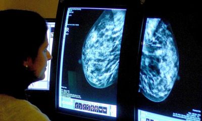 NHS to offer women in England drug that cuts recurrence of breast cancer