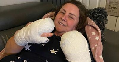 Woman has EIGHT fingers amputated after mystery illness causes them to turn black