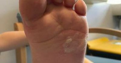 Mum's warning over beach barbecues and bonfires after boy, 4, burns foot on sand