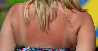 TikTok 'hacks' to treat sunburn branded harmful by health expert