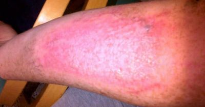 NI woman’s warning on dangerous plant which left her battling severe burns for years