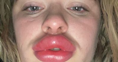 Mum laughed at by doctors after rushing to get help for swollen 'fish lips'