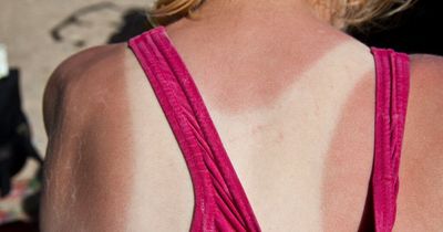 'Quick fix' sunburn treatments you should avoid as they could do more harm than good