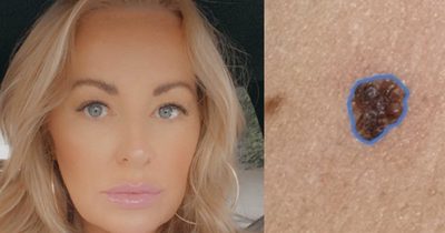 Scots mum 'diagnosed' own with skin cancer with app from smartphone