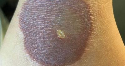 Ten-year-old girl could need surgery for burns after following Tik Tok trend