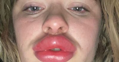 Mum looks like 'blow-up doll' after lip filler reaction - even doctors laughed at her 'fish lips'