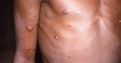 Monkeypox cases in Scotland increase to 18