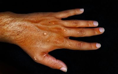 Monkeypox cases in UK surge by 38% as hundreds of new infections detected