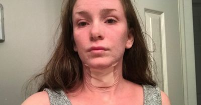 Woman's hair falls out and she's awake for FIVE days after giving up skin cream