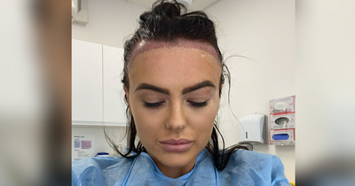 Love Island's Rosie Williams shows off secret hair transplant procedure