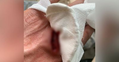 Man who sliced through hand with mitre saw left in agonising pain after operations cancelled TWICE