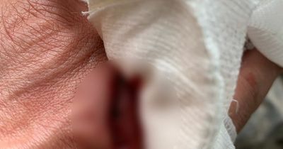 Man who sliced through hand with saw left in limbo as operation cancelled twice