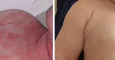 Baby boy with itchy and painful eczema completely cleared in two days by £5.50 Boots cream