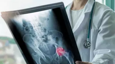 Bengaluru: Rare cell therapy enables 38-year-old man to reverse bone death syndrome