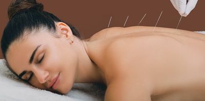 Physio 'dry needling' and acupuncture – what's the difference and what does the evidence say?