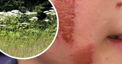 Mum's warning as son, 12, suffers 'raw burns' from Britain's most dangerous plant
