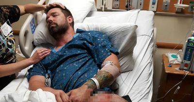 Dad left with 'excruciating' third degree burns on leg after vape 'exploded' in pocket