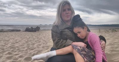 Girl, 7, faces skin-graft surgery after burning her foot on barbecue buried on beach