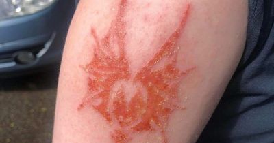Mum's henna warning after schoolboy, 10, suffers chemical burn and is left with scar of 'tattoo'