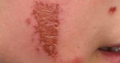 Giant Hogweed: Son left with severe burns from 'UK's most dangerous plant'