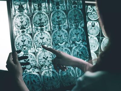 Flu Shots Can Cut Down Risk Of Alzheimer's, Exploratory Study Finds