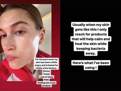 Hailey Bieber shares unfiltered selfie of ‘irritated and inflamed’ skin