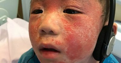 Boy nearly dies after suffering from eczema so bad it left his skin leaking