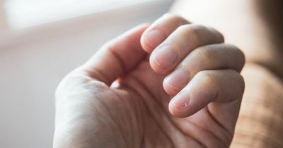 Having white or pale nails could be symptom of heart failure or liver disease