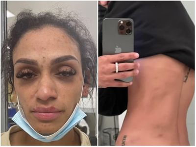 NBA player’s wife posts photos of her injuries after he turns himself in on domestic abuse charge
