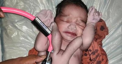 Woman gives birth to 'miracle' baby girl who has four arms and four legs