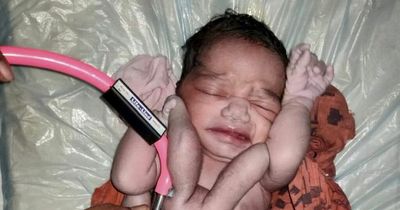 Baby born with four legs and four arms hailed a 'miracle' and 'reincarnation of God'