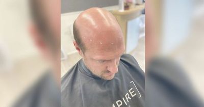 Bald man 'looks 20 years younger' after having hairpiece fitted