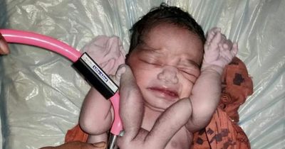 Baby born with four arms and four legs in India is hailed a 'miracle'