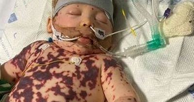 Mum’s warning after ‘tiniest mark’ on baby’s skin turns into nightmare meningitis ordeal