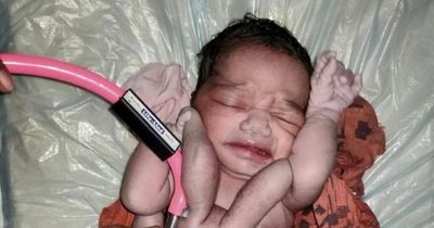 Tot born with four legs and four arms hailed as 'miracle of nature'